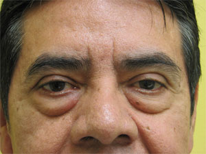 Bepharoplasty