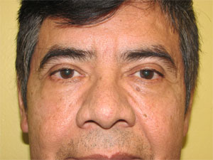 Bepharoplasty