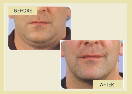  Facial Rejuvenation - Chin Removal