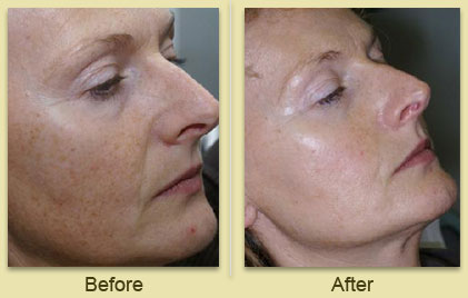 IPL Treatment