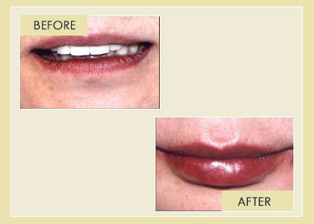 Facial Rejuvenation - Lips Augmentation