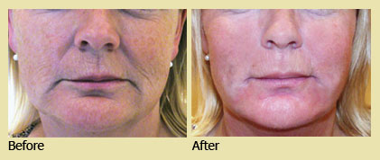 Sculptor Body - Radiesse Treatment 