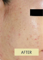 Radiesse Treatment
