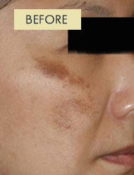 Radiesse Treatment