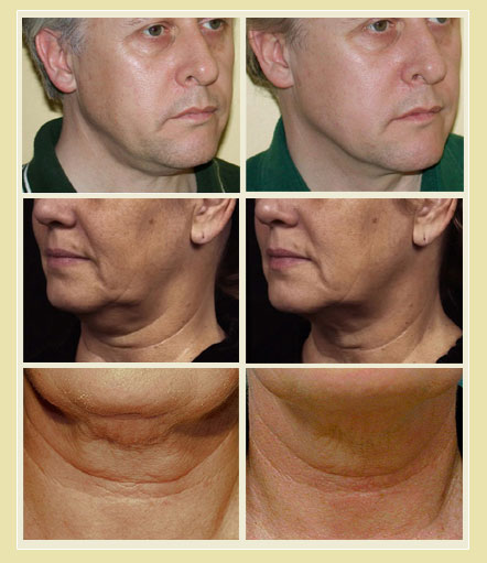 Sculptor Non-Surgical Treatments - Thermage