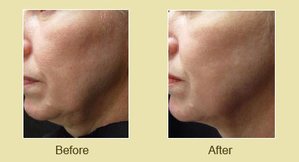 Titan Laser Treatment