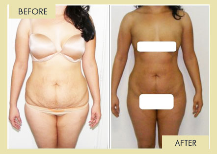 Toning Treatment