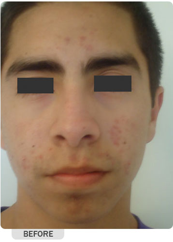 Acne Treatment