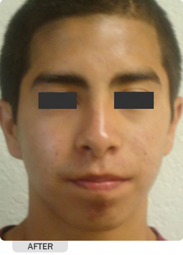 Acne Treatment