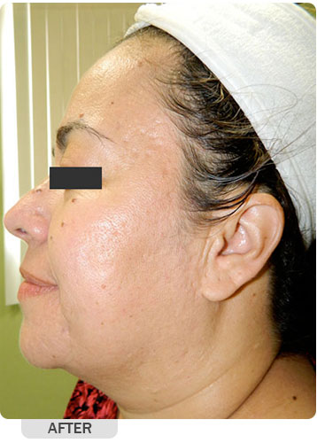 Facial Rejuvenation