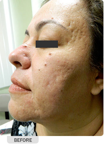 Facial Rejuvenation