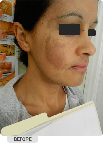 Facial Rejuvenation