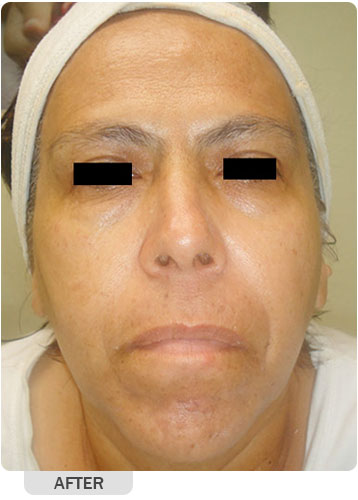 Sensitive Skin Treatment